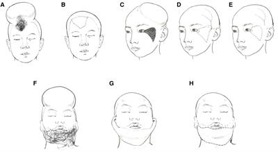 Reconstruction of facial defects using a pre-expanded scalp flap: A description of the method used and outcomes of 43 patients